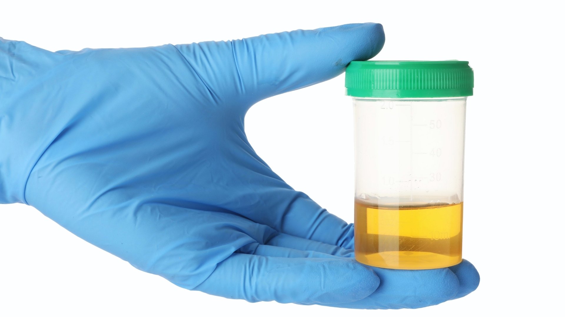 how long does fentanyl stay in urine It is typically detectable for 1-3 days