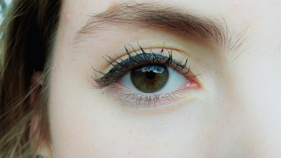 alcoholic eyes can have a glazed or glassy look.
